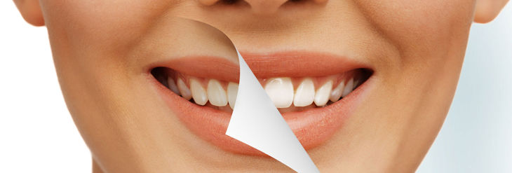 Blanqueamiento dental distintos tipos Blanqueamiento dental distintos tipos