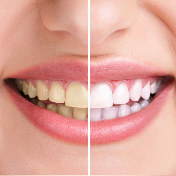 Blanqueamiento Dental