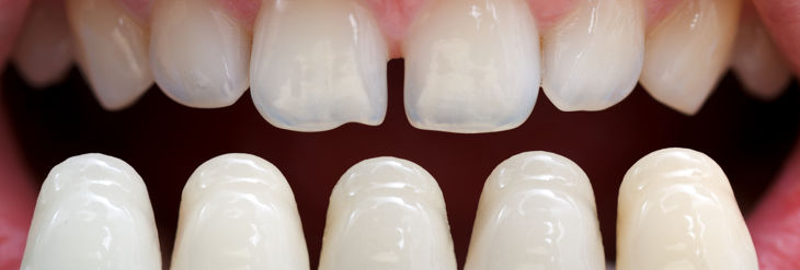 Carillas Dentales Carillas Dentales