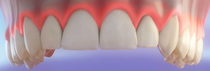 Cirugía con Láser Dental
