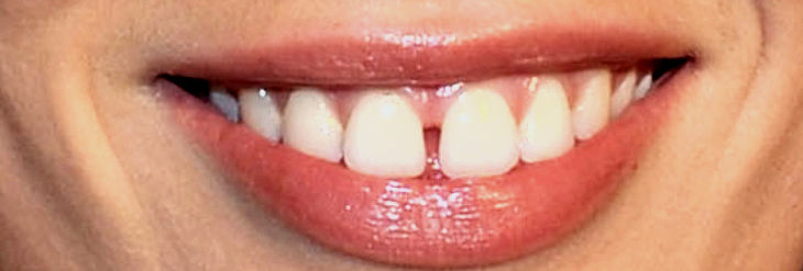 Dientes Separados - Diastema Dientes Separados - Diastema