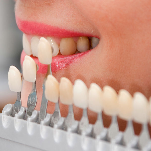 Estética Dental