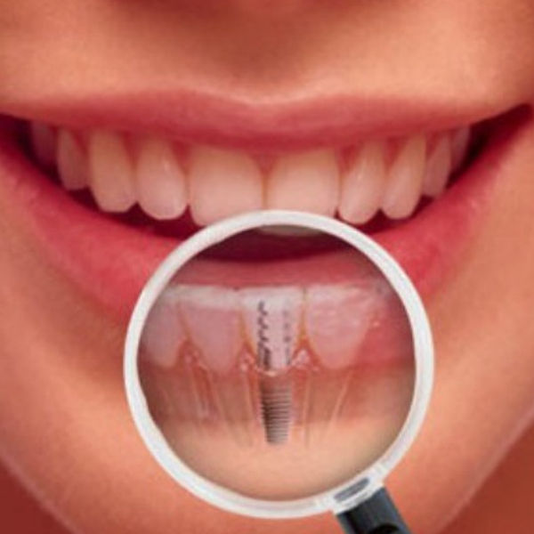 Implante Dental