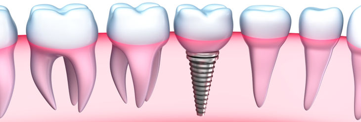 Implantes Dentales Implantes Dentales
