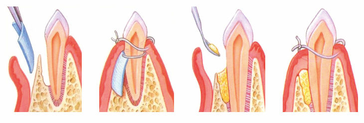 Microcirugía Periodontal
