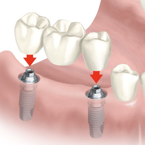 Prótesis Dental