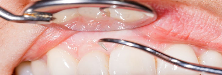 ¿ Qué es la periodoncia ? ¿ Qué es la periodoncia ?