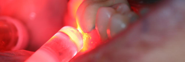 Sensibilidad con Láser Dental Sensibilidad con Láser Dental