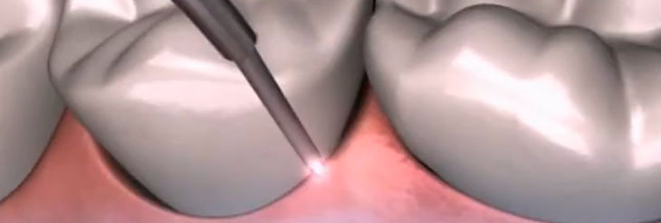 Tratamiento Periodontal Láser Asistido