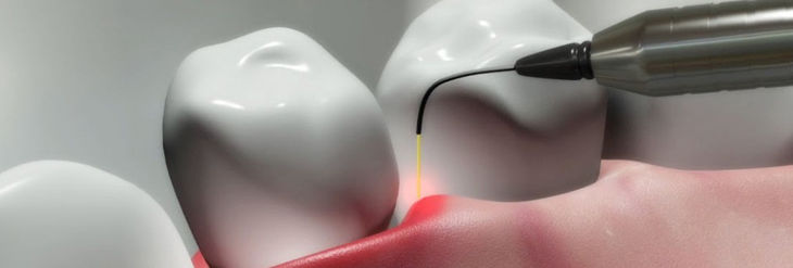 Ventajas del Láser Dental Ventajas del Láser Dental
